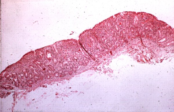 Small intestinal lining of patient with untreated celiac.